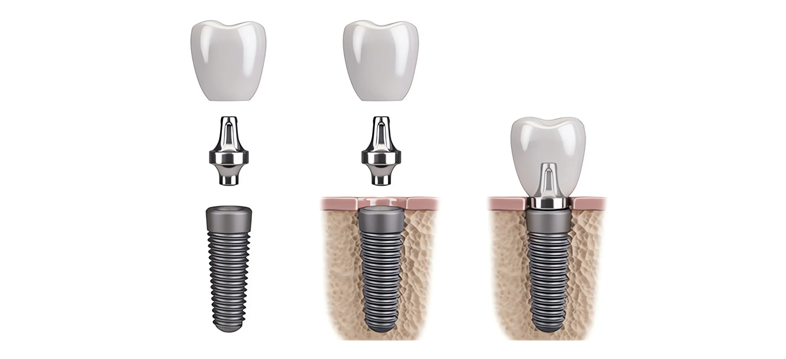 Impianti dentali Dottor Bartolomeo Ariano Odontoriatria dentista Torino denti fissi