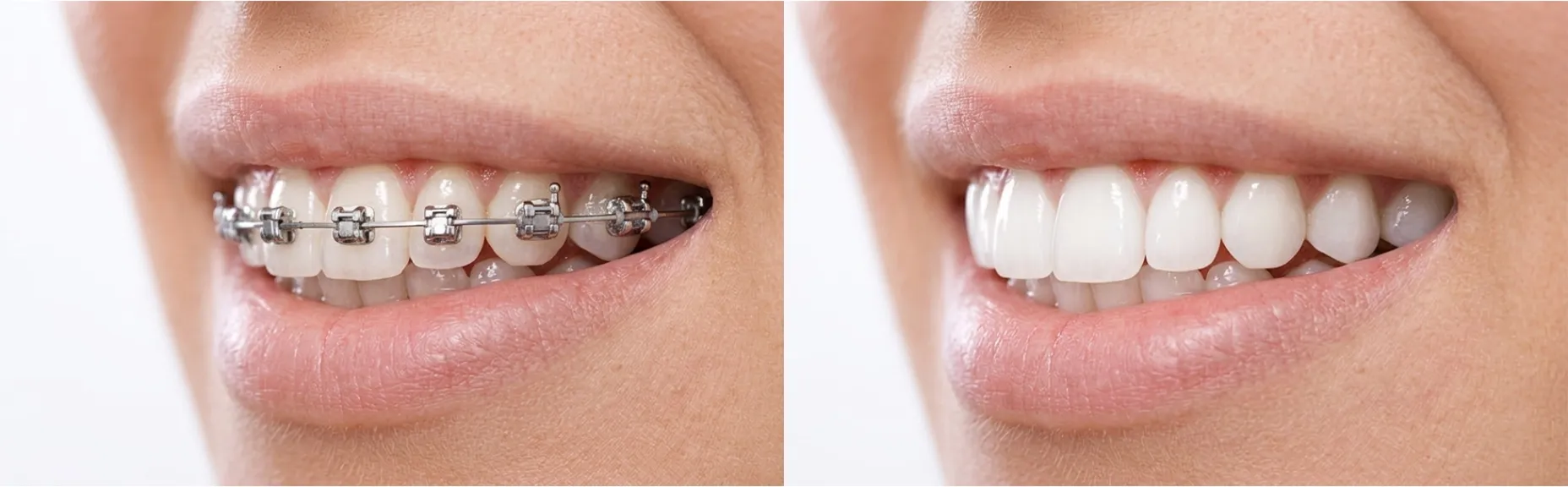 Ortodonzia tradizionale fissa dottor Bartolomeo Ariano, odontoiatria, dentista Torino | Apparecchio fisso